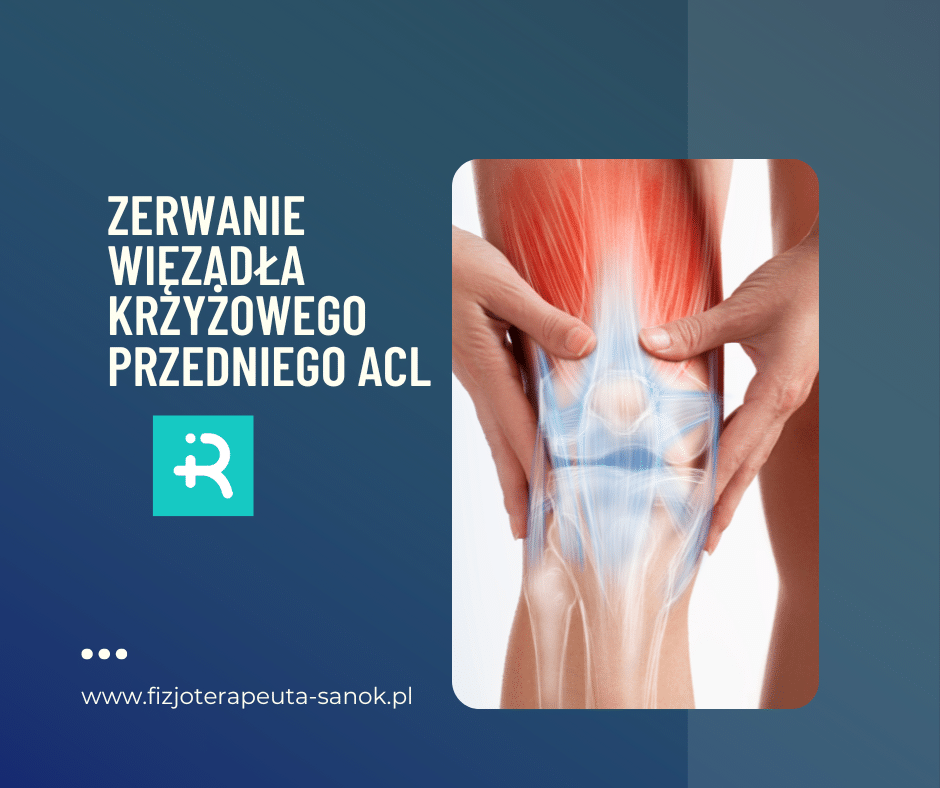 Zerwanie ACL - wiązadło krzyżowe przednie