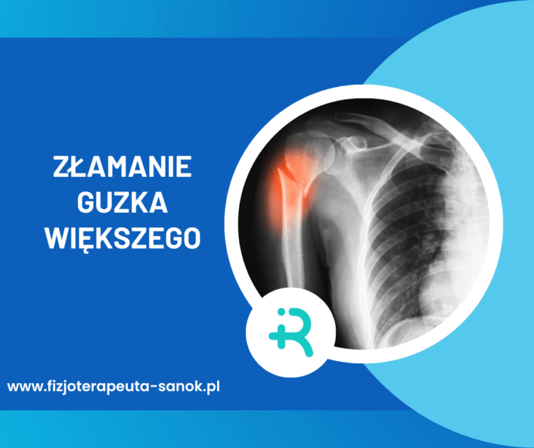 RTG złamania guzka większego kości ramiennej.
