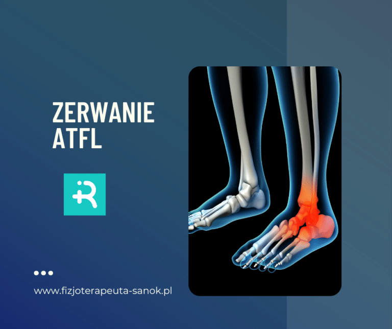 Zerwanie ATFL - uraz kostki.